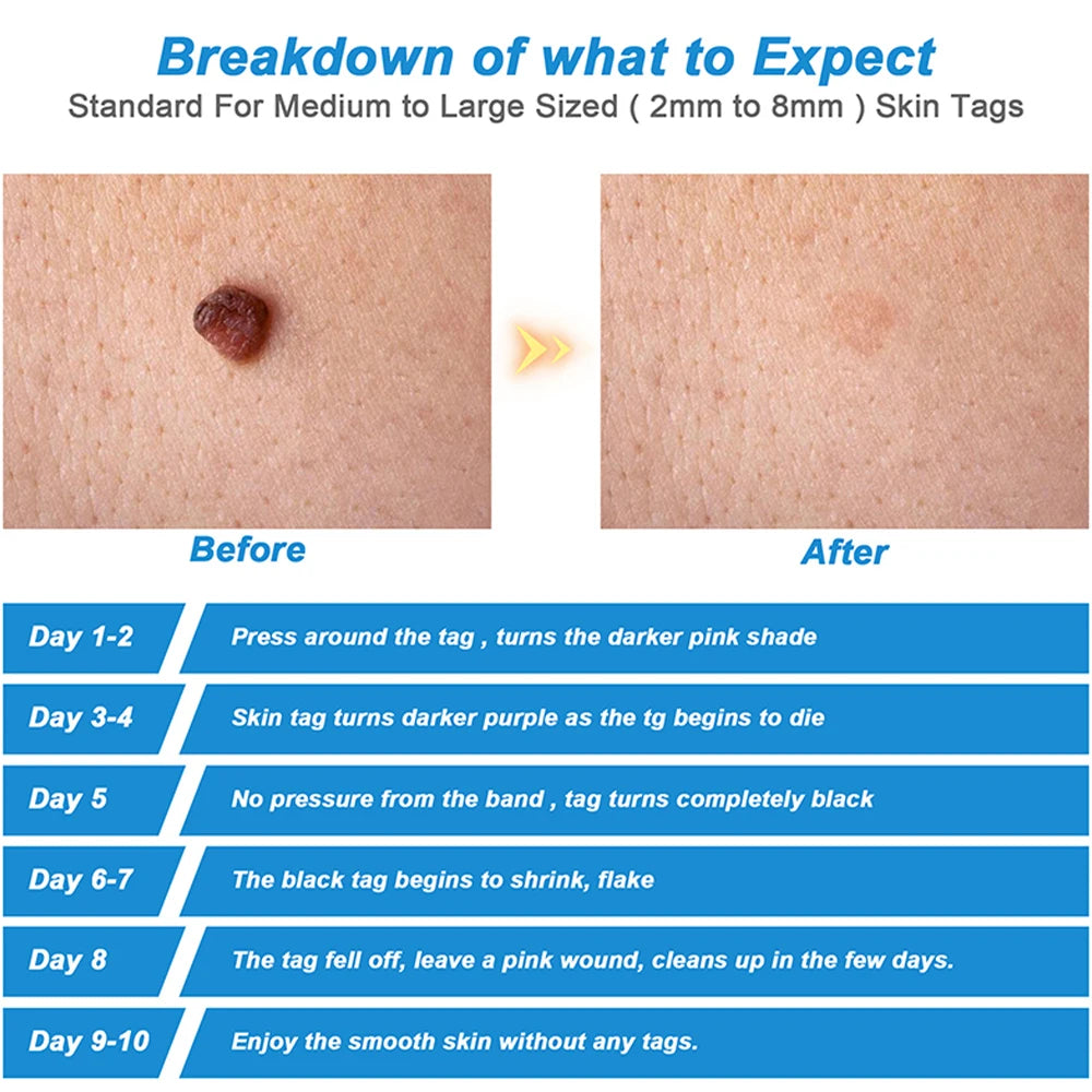 Micro Skin Tag Remover Device - Adult Mole Wart Remover